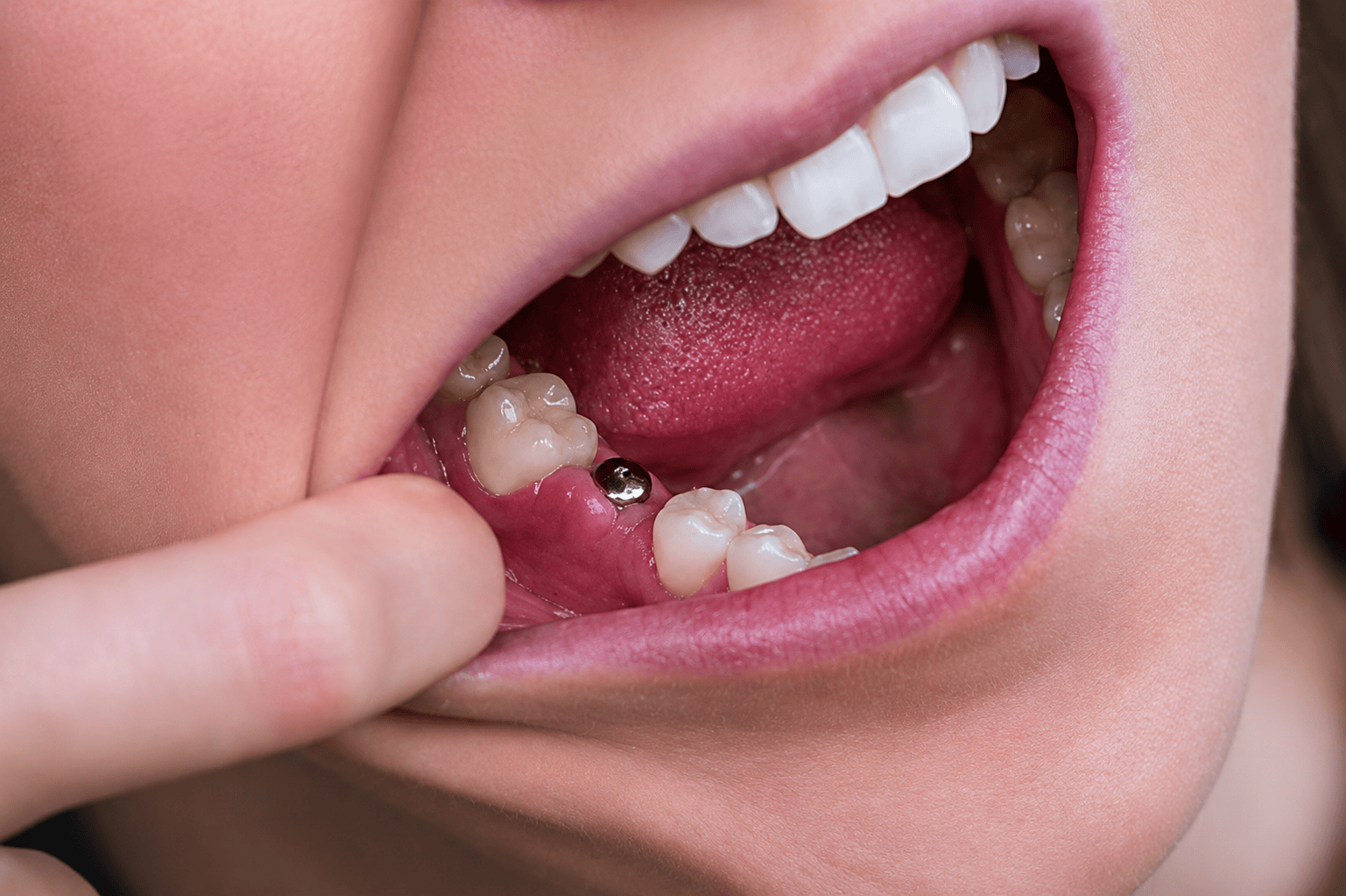 Primer plano de un implante dental en la mandíbula inferior de una persona, mostrando dientes y encías durante un examen de salud bucal.