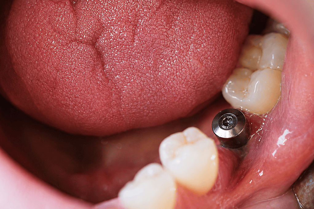 Primer plano de un implante dental en la boca, junto a dientes molares naturales, ilustrando cirugía bucal y cuidado dental.