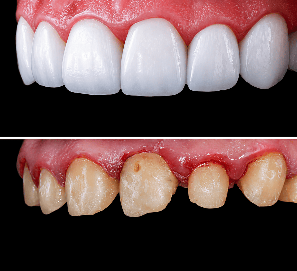 Transformación de carillas dentales antes y después, destacando la mejora en la estética y salud dental.