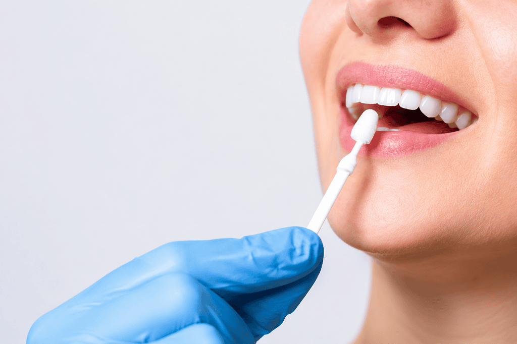 Persona aplicando gel blanqueador dental con un hisopo, usando guantes azules, mostrando dientes blancos y sanos.