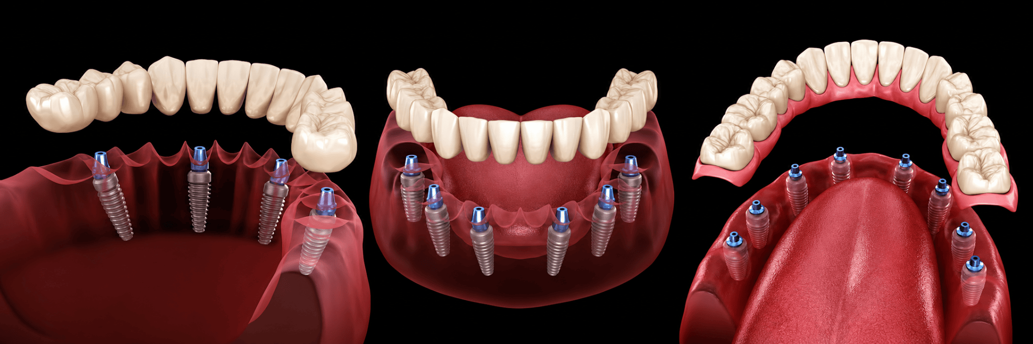 3D illustration of dental implants and crowns, showcasing a complete arch restoration in an open mouth view.