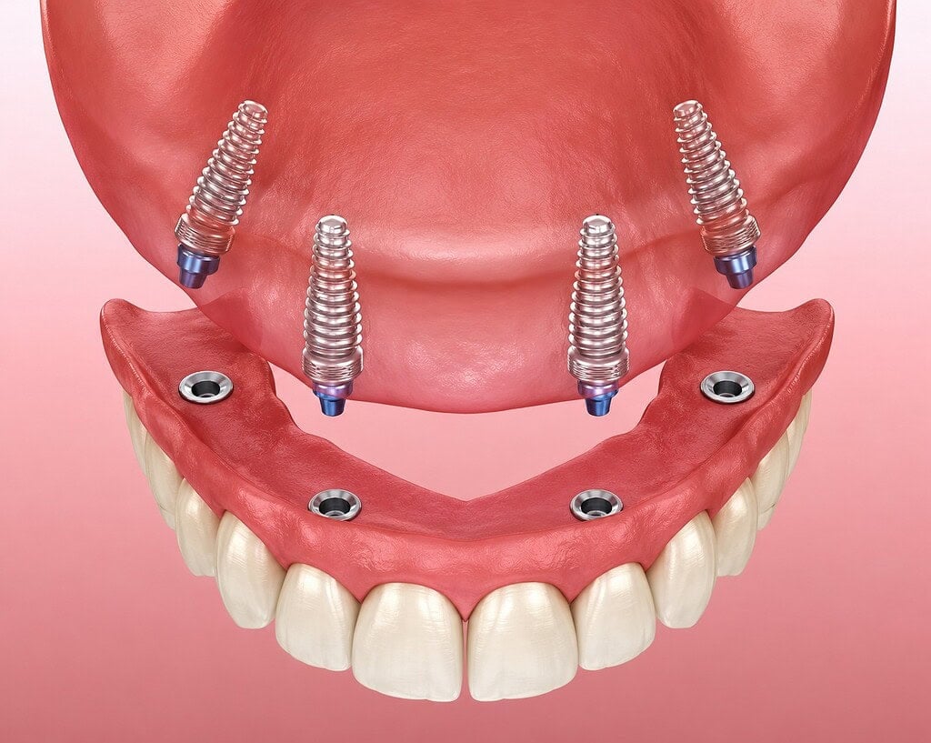 Illustration d'un implant dentaire montrant les emplacements des vis pour les prothèses et la fixation à la mâchoire.