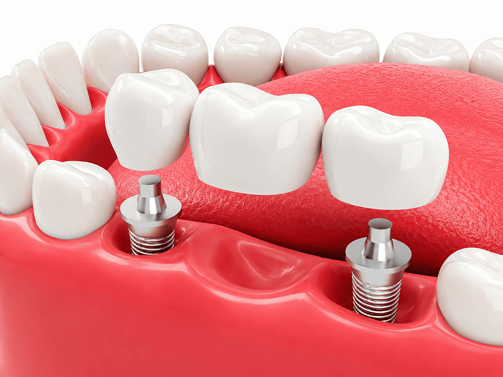 Dental implants illustration showing artificial tooth placement in gums.